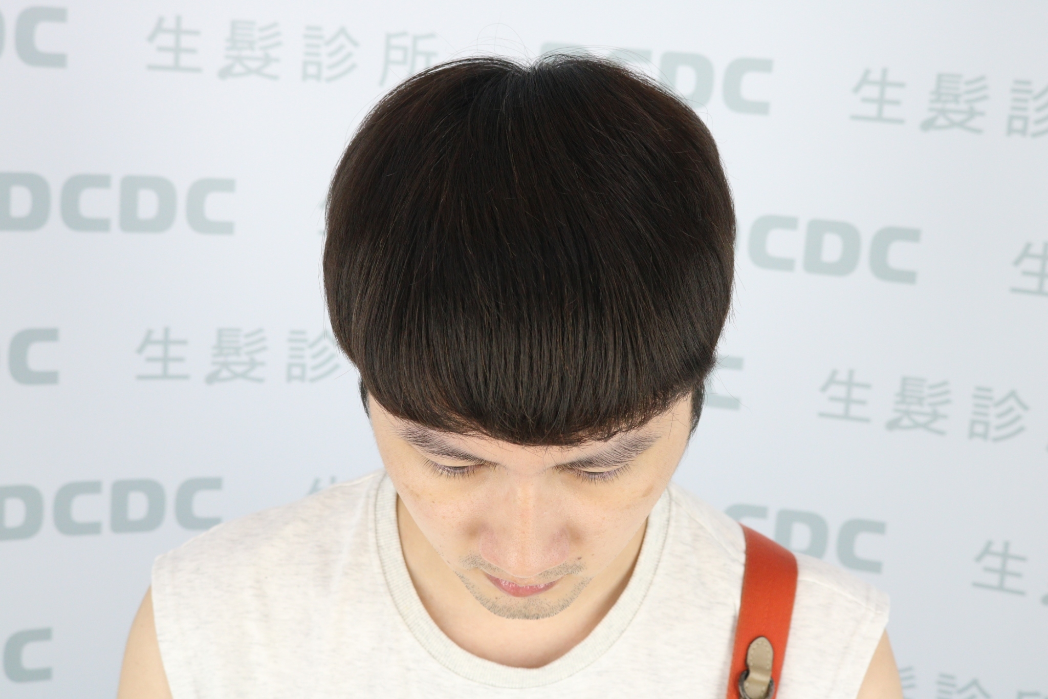 DCDC生髮診所-高密度植髮填補額角空洞術後自然層次感